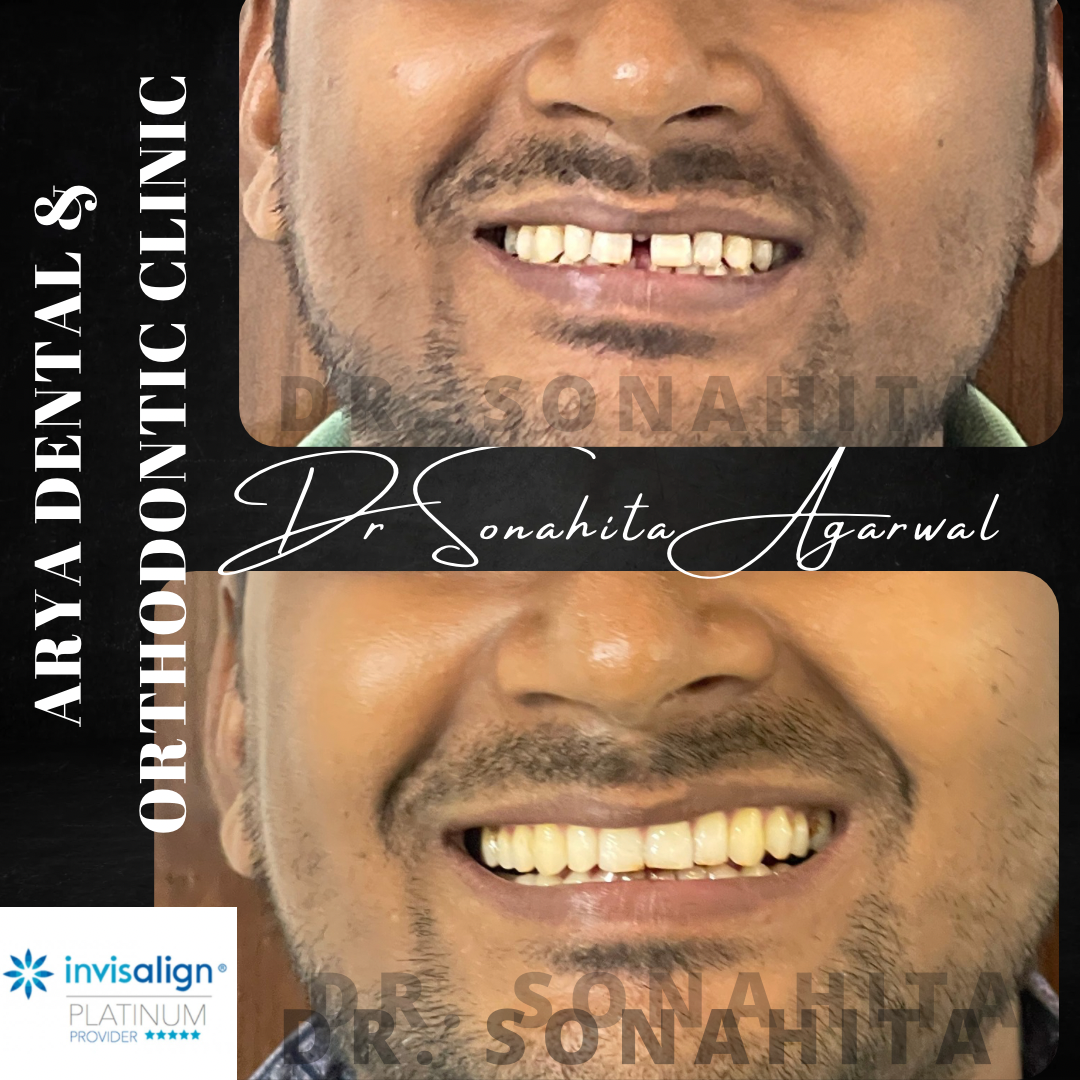Patient smile transformation 1